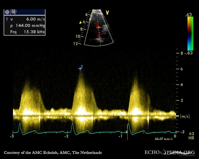 价值敏感设计 / 道德服务设计——Perimembraneous VSD E00684 (CardioNetworks ECHOpedia)
